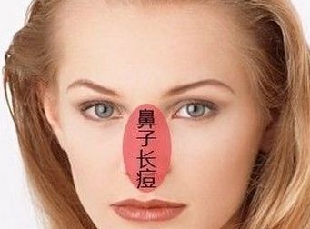 成都祛斑祛痘 成都祛斑祛痘